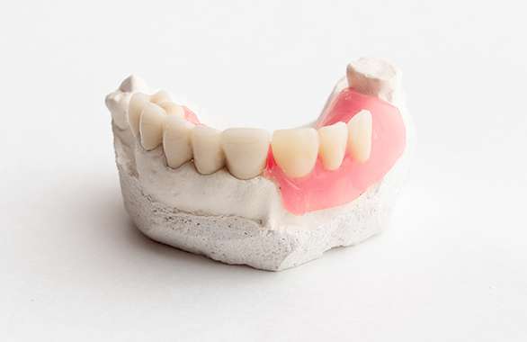 歯を失った時 義歯・入れ歯・インプラント治療（補綴治療）