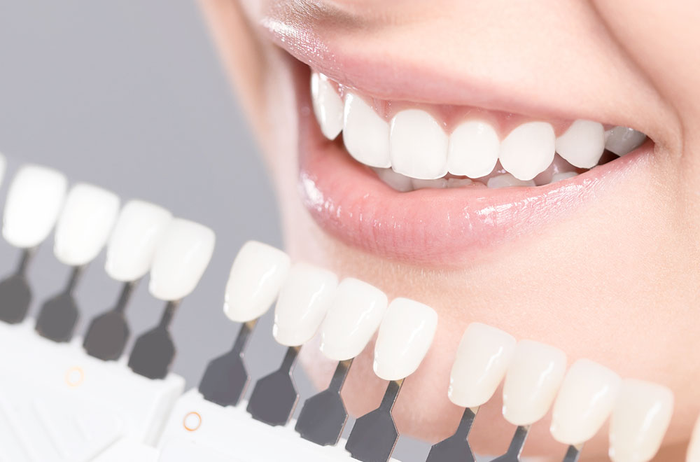 より美しい歯を目指す  ホワイトニング・白い詰め物（審美歯科）
