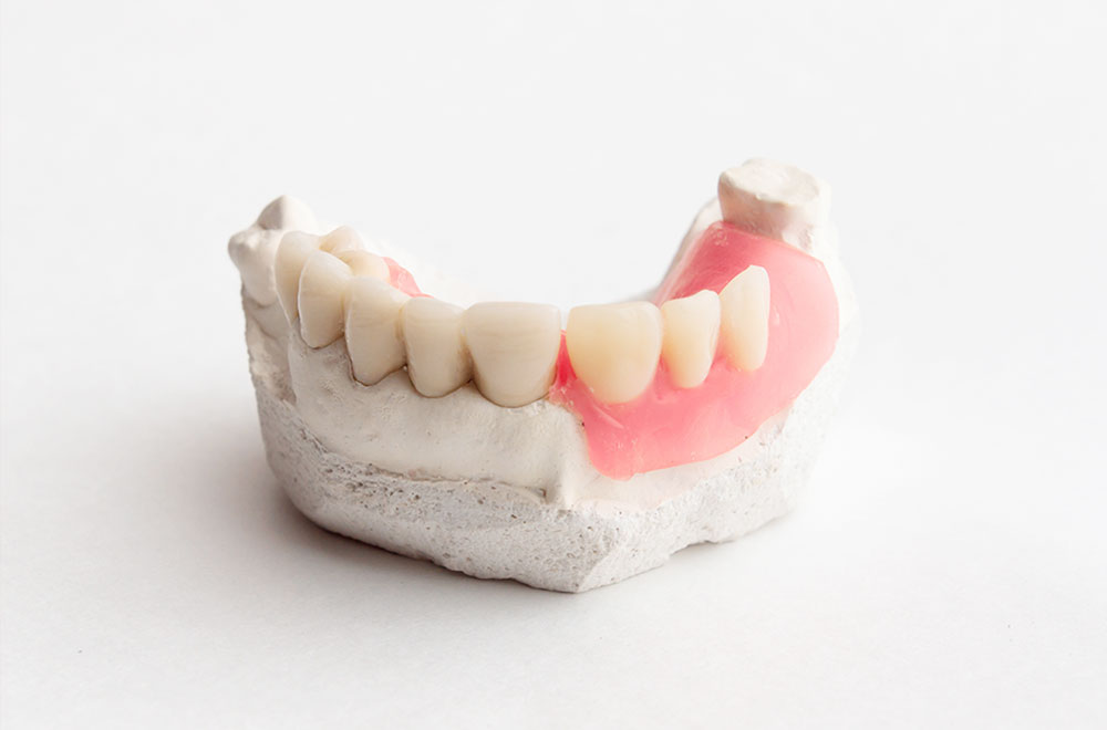 歯を失った時（義歯・入れ歯治療）・インプラント治療