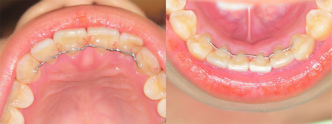 歯並びがきになる プチ矯正 矯正歯科 香里園 もりした歯科医院