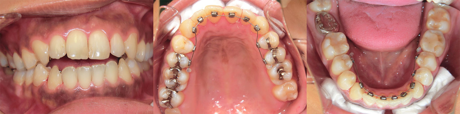 歯並びがきになる プチ矯正 矯正歯科 香里園 もりした歯科医院